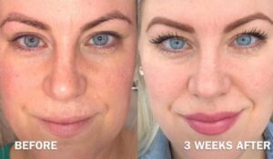 Before and After