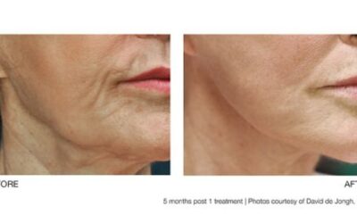 Profound Microneedling Device Named “New Treatment of the Year”