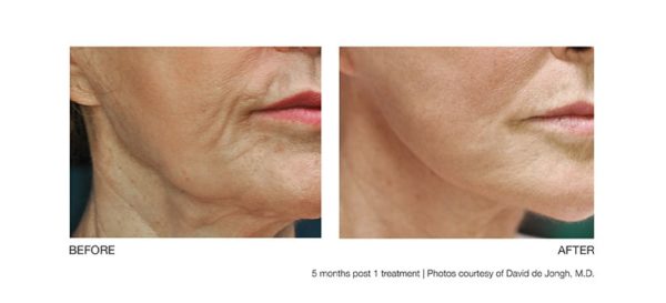 Profound Microneedling Device Named “New Treatment of the Year”