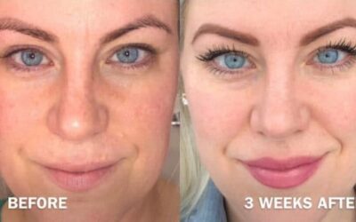 PRP Microneedling – Stimulate your Natural Collagen