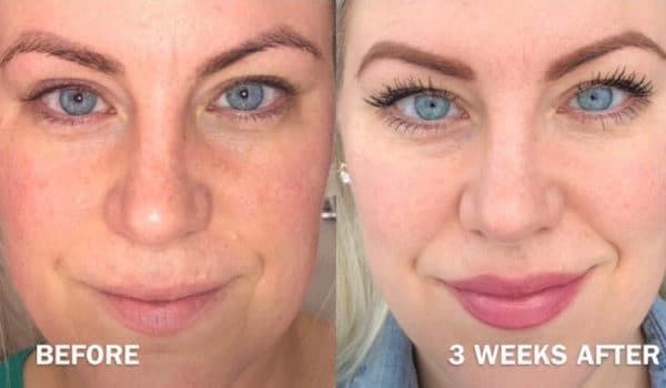 PRP Microneedling – Stimulate your Natural Collagen