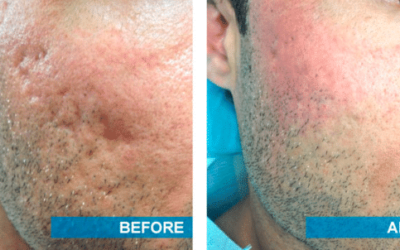 WHAT ARE YOUR OPTIONS FOR EFFECTIVE SCAR TREATMENT?
