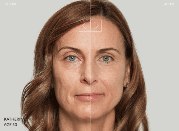 comparison of woman before and after procedure