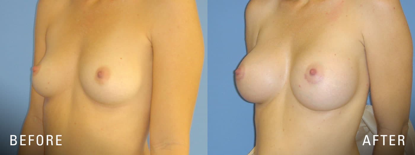 Breast Augmentation with Illume