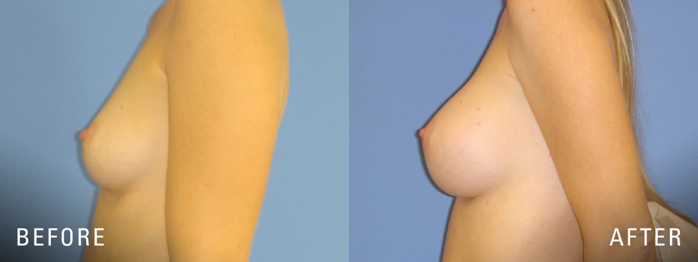 before and after breast surgery