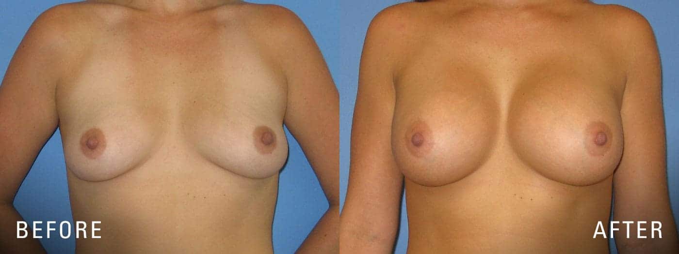Breast Augmentation Example
