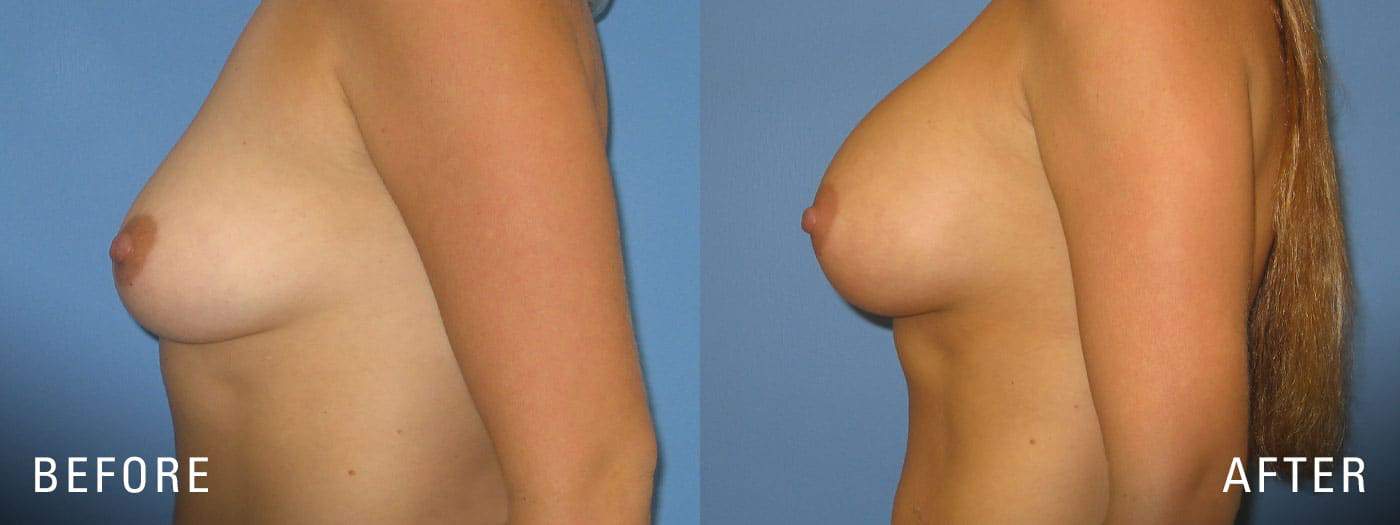 Breast Implants Results
