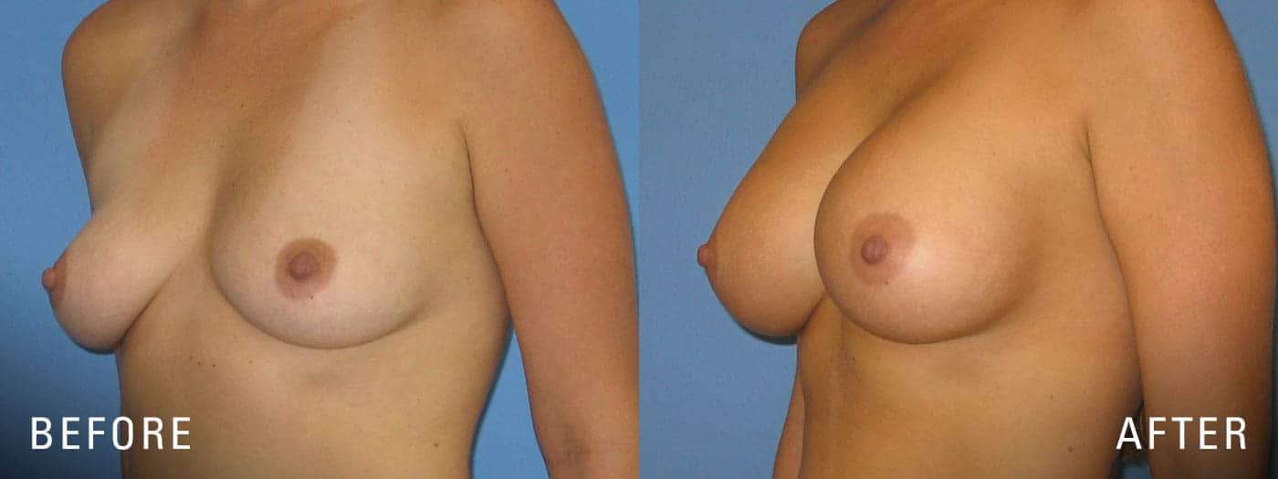 Breast Implants Before and After
