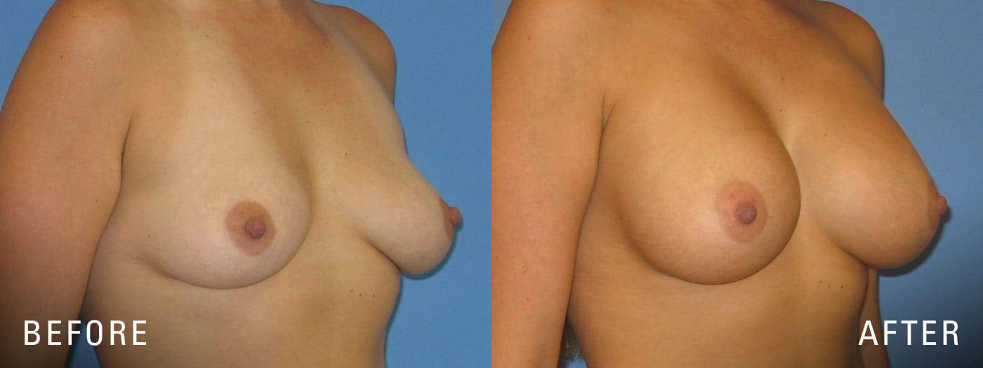 Breast Implant results