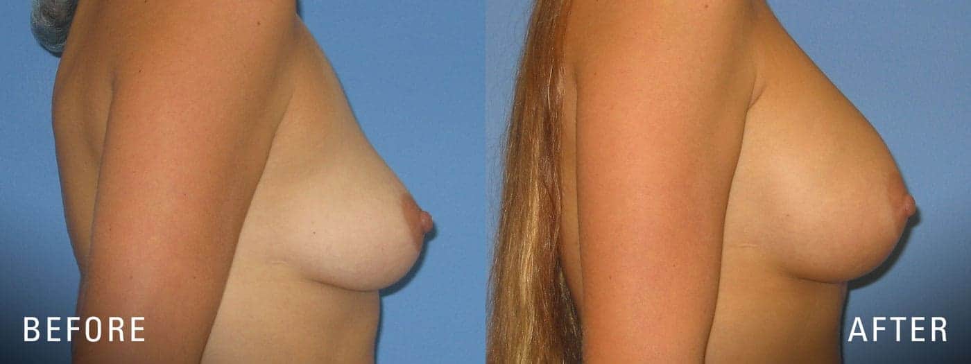 Breast Implant Before and After