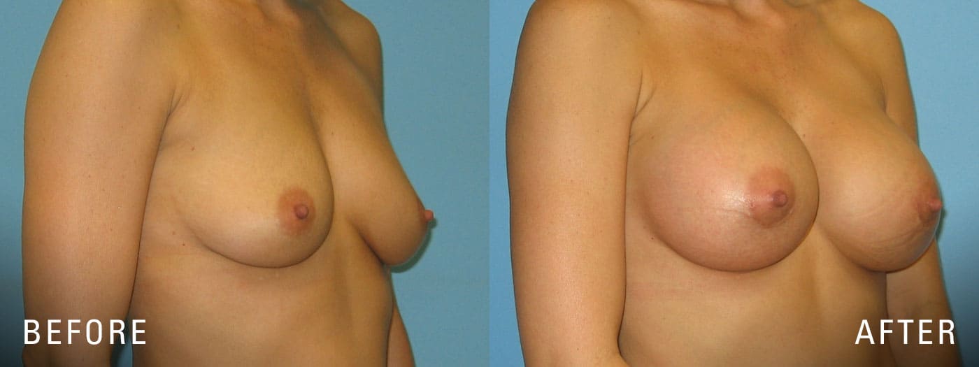 Before and After breast surgery
