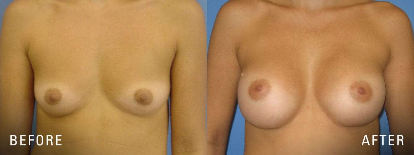 Before and After breast surgery