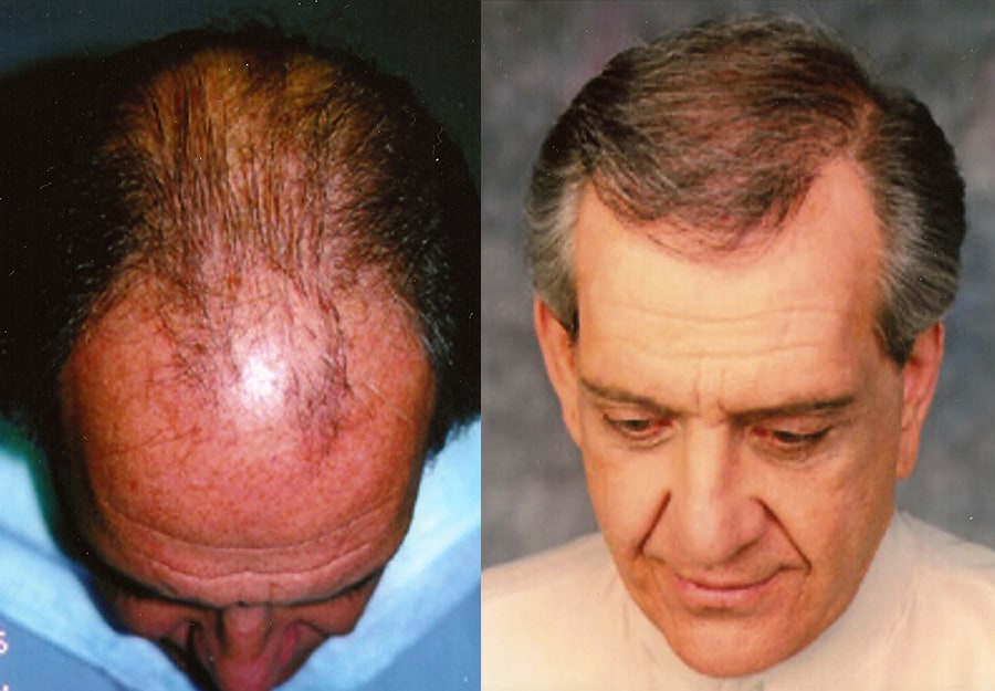 before and after hair loss