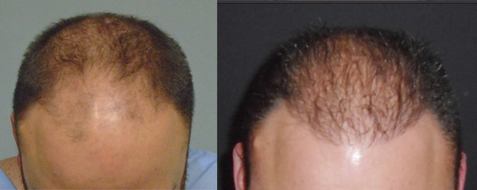 hair loss before and after