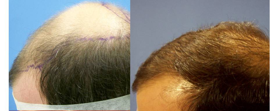 before and after hair loss