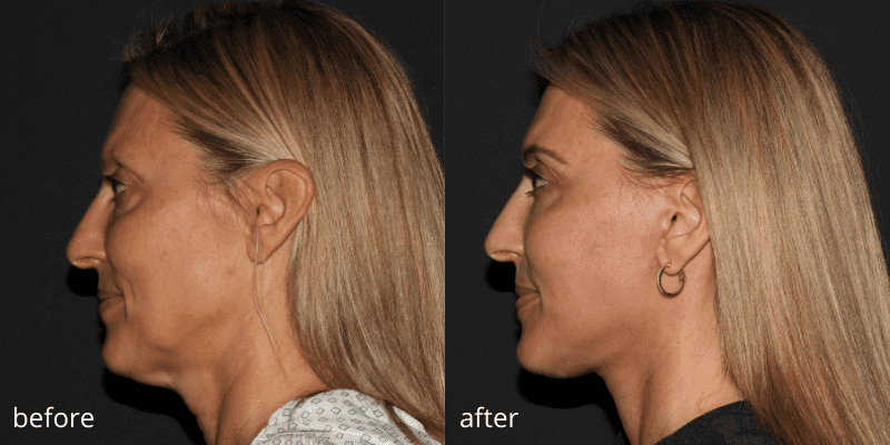 before and after face lift surgery