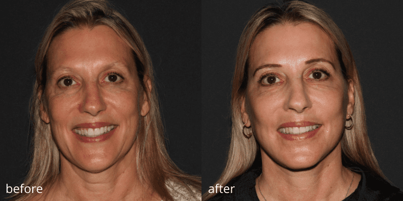 before and after facelift surgery