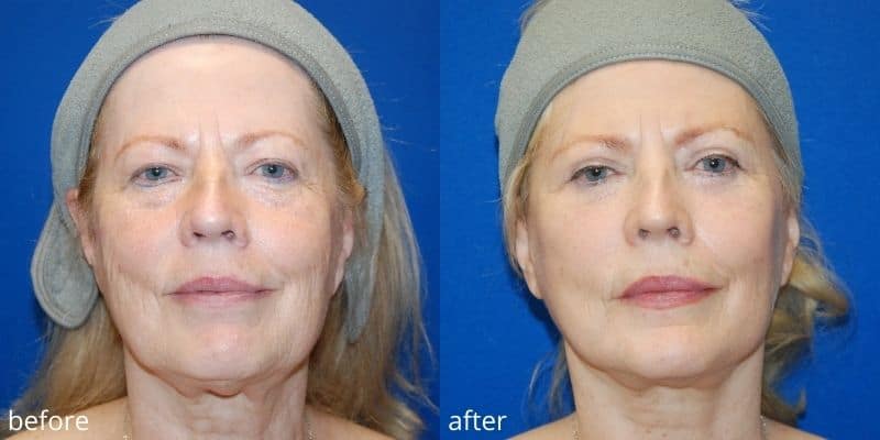 Before and After surgery procedure