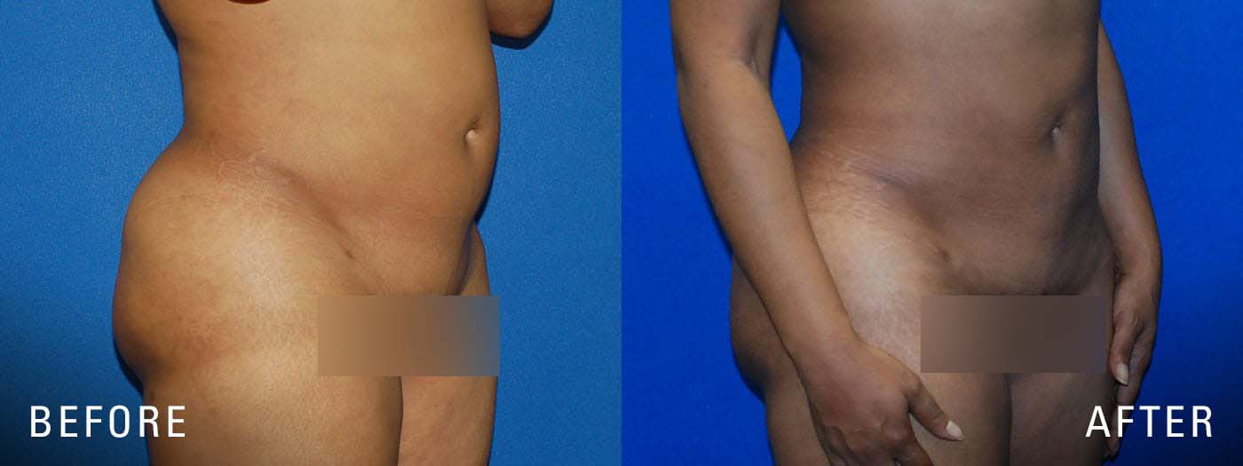 before and after BBL liposuction surgery