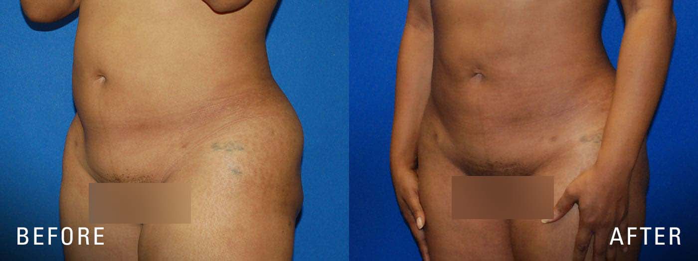 before and after BBL liposuction surgery