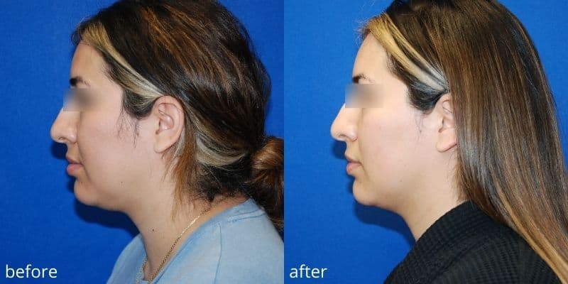 before and after Submental liposuction surgery