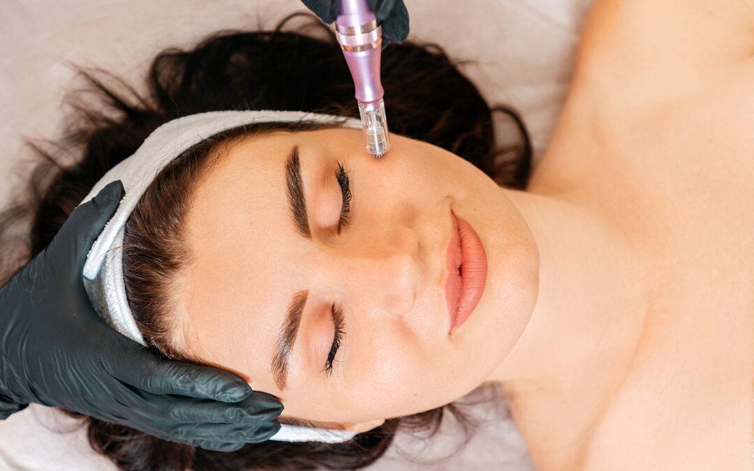 Microneedling