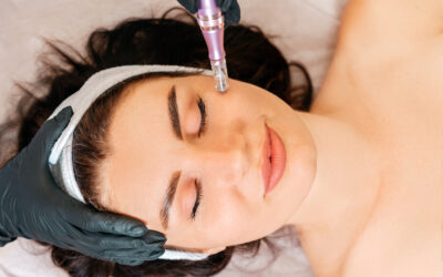 Microneedling, Major Results: How to Get Younger, Fuller, Smoother Skin with Microneedling