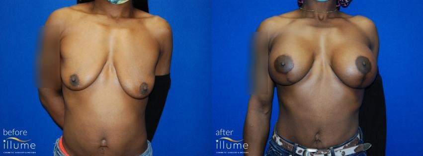 surgery breast before and after