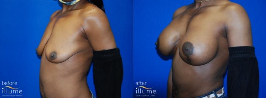 surgery breast before and after