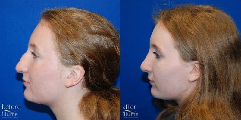 nose job before and after