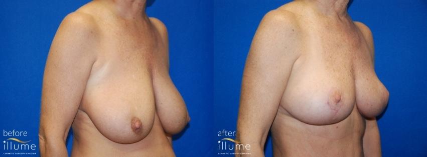 before and after surgery
