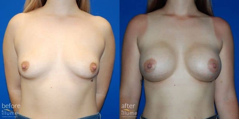 breast surgery before and after