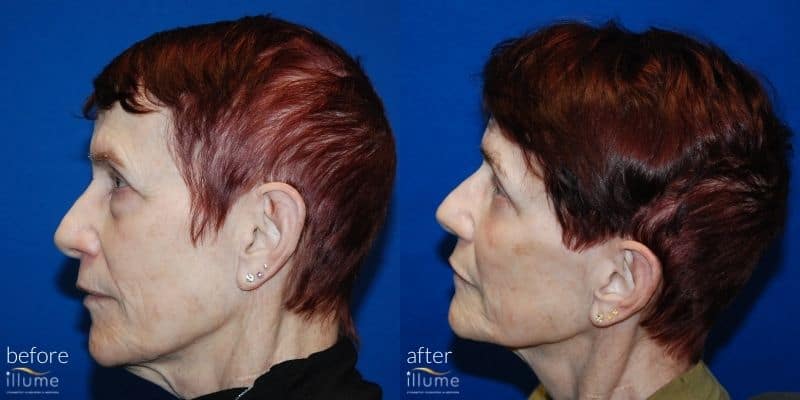 before and after pic of surgery of chin or neck