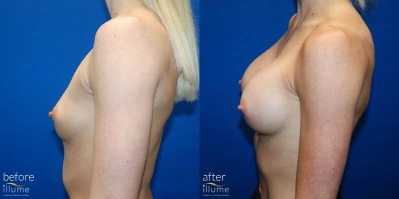 before and after picture of surgery
