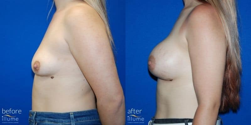 breast surgery before and after