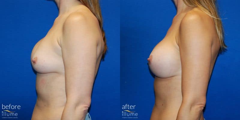 before and after breast surgery