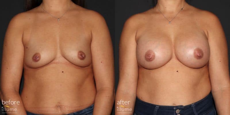before and after surgery photo