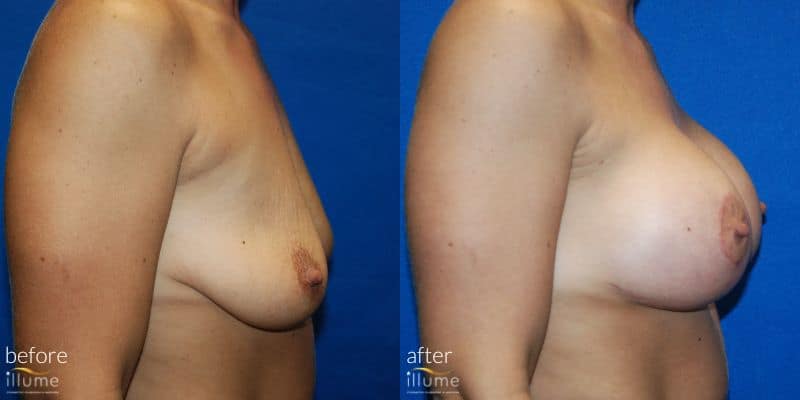 before and after surgery photo