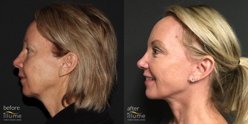 before and after procedure of blonde woman