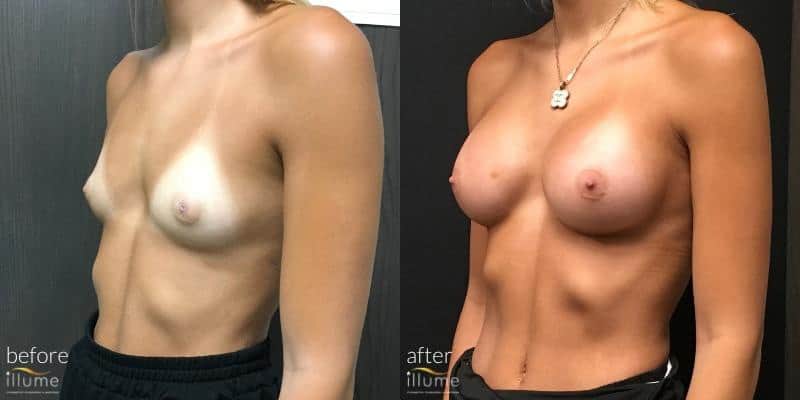 Before and After of surgery