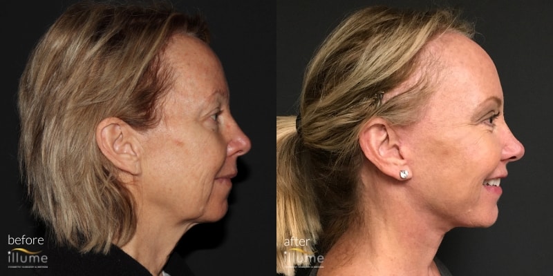 before and after procedure of blonde woman