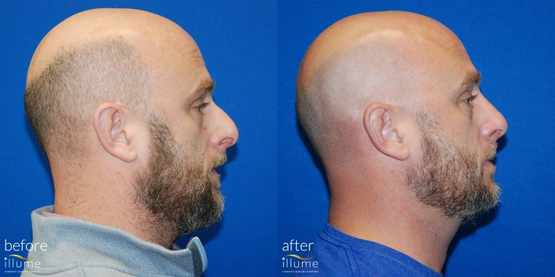 Before and After of Laser Hair restoration