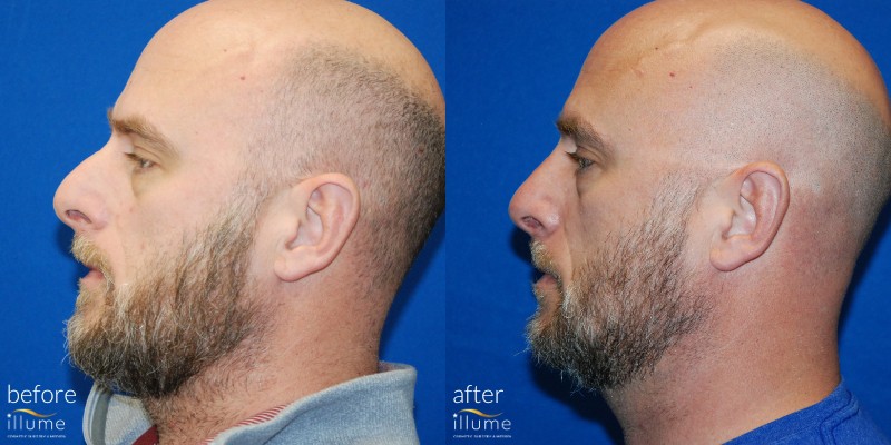Before and After Laser Hair restoration
