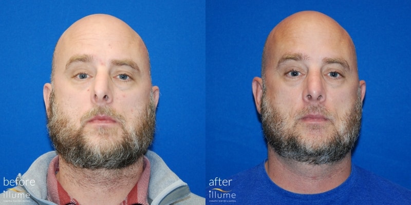 Before and After Hair restoration