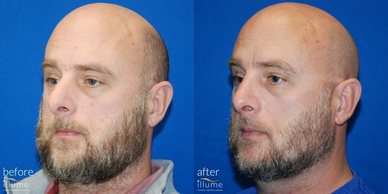 Before and After of Laser Hair Restoration