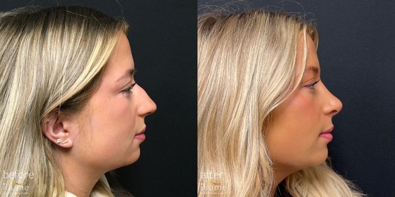 before & after rhinoplasty at illume