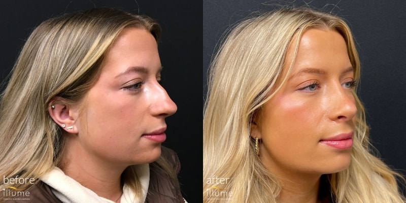 before & after rhinoplasty at illume